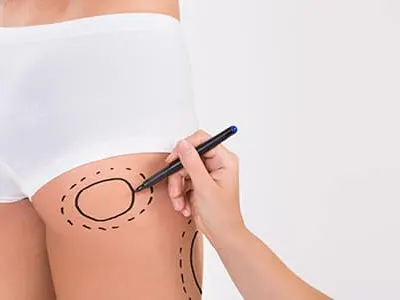 A hand marking circles on a woman's thigh with a black pen, in white shorts