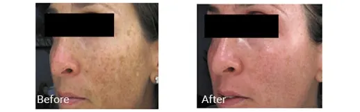 Before & After Image of Fraxel Laser Repair Hollywood FL