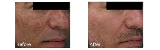 Imagen de antes y después del tratamiento facial con IPL en el condado de Broward, Florida