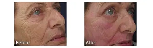 Before & After Image of Pixel CO2 Laser Broward FL