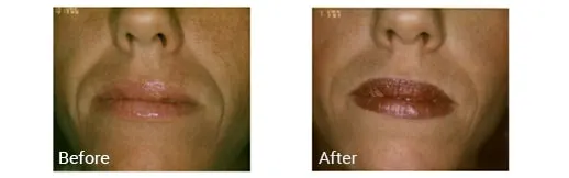 Before & After Lip Fillers Pembroke Pines FL
