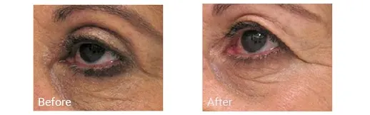 Antes y después de la cirugía de párpados en Hollywood, FL