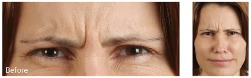 Before & After Image of BOTOX Injection Broward County FL