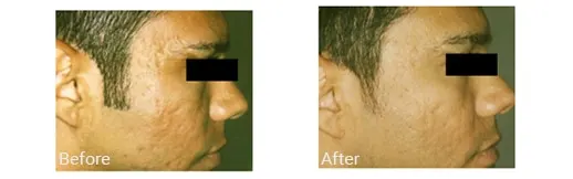 Before & After Image of Fraxel Laser Repair Broward FL