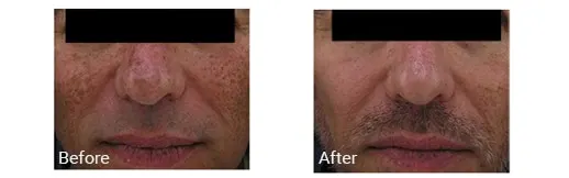Imagen de antes y después del tratamiento facial con IPL en Hollywood, Florida