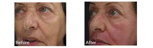 Before & After Image of Pixel CO2 Laser Hollywood FL