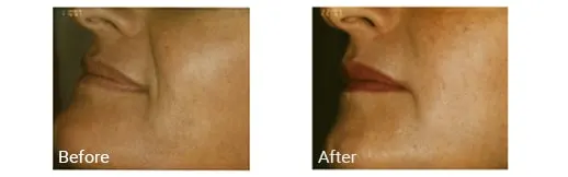 Before & After Lip Fillers Hollywood FL