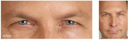 After blepharoplasty