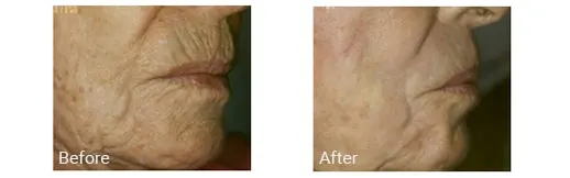 Imagen de antes y después del tratamiento con láser de CO2 en Broward, FL