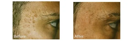 Before & After Image of Microthermal Treatment Broward FL