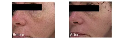 Imagen de antes y después del tratamiento facial con IPL en Hollywood, FL