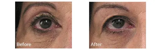Antes y después de la blefaroplastia en el condado de Broward, Florida