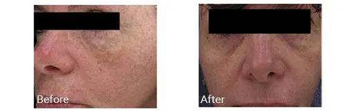 Imagen de antes y después del tratamiento facial con IPL en Doral, FL