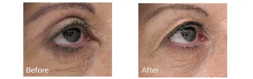 Blefaroplastia antes y después en Doral, Florida