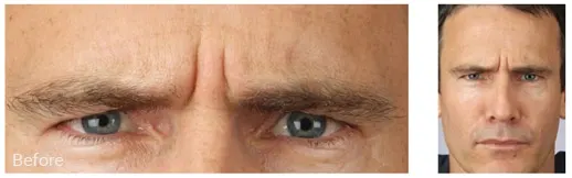 Before blepharoplasty