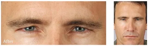 After blepharoplasty