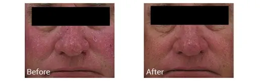 Imagen de antes y después del tratamiento con IPL en Pembroke Pines, Florida