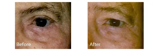 Blefaroplastia antes y después en Hollywood, Florida