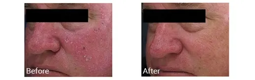 Imagen de antes y después del tratamiento con IPL en Doral, FL