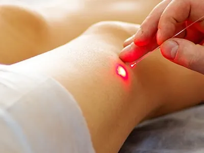 A clinician's hand holds a thin laser fiber with a red light spot against a model's lower leg