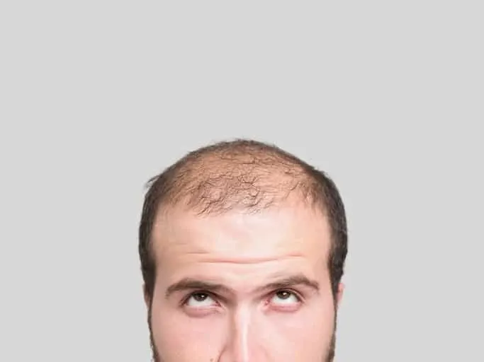 PRP for Hair Loss
