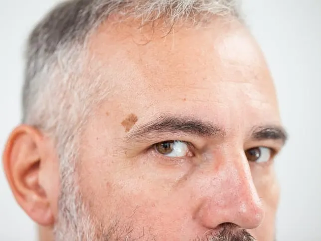 Are Birthmarks Harmful