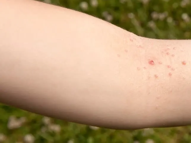 Molusco contagioso