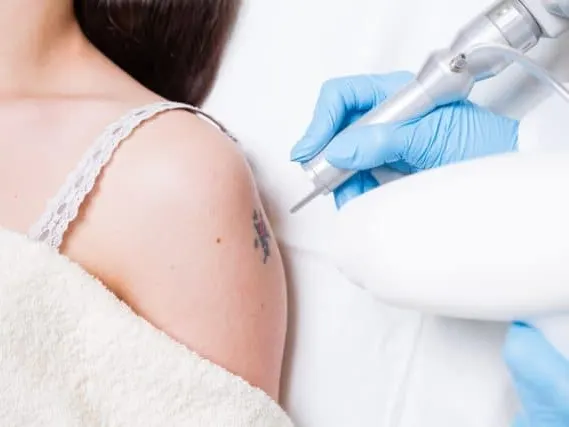 woman getting laser tattoo removal