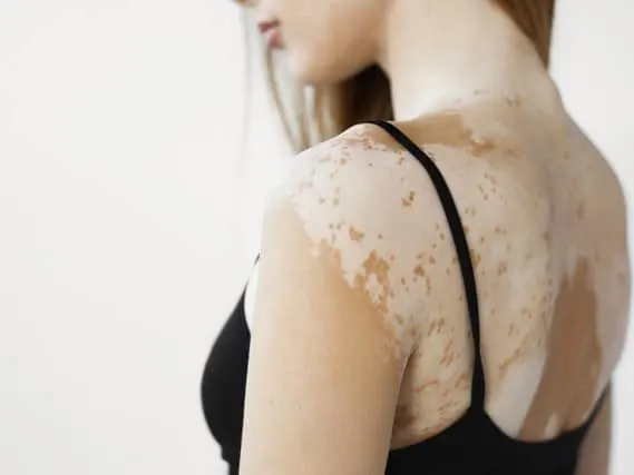 Una mujer vista de espaldas con una blusa negra, con manchas claras en la piel del hombro y la espalda.