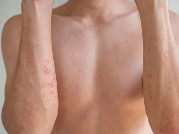 A person's bare chest and forearms with scattered red spots on the skin.