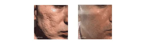 Before & After Image of ArteFill Hollywood FL
