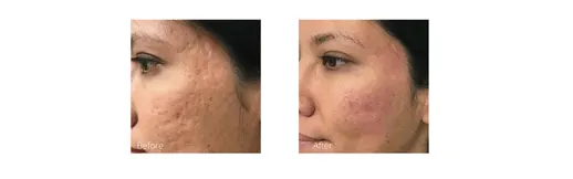 Before & After Image of Bellafill Hollywood FL