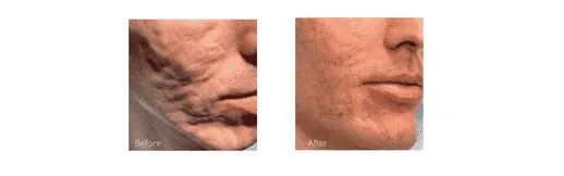 Before & After Image of Bellafill Broward County FL