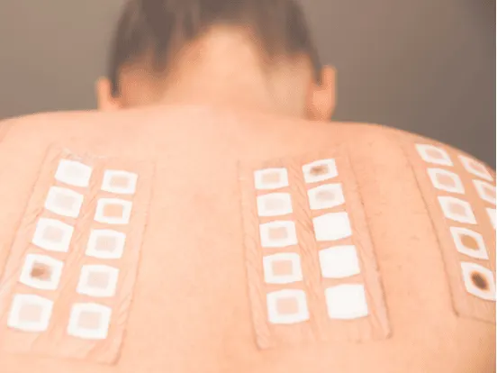 Allergy patch test on the back of a young woman