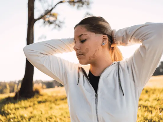 bella adolescente con una marca de nacimiento en la cara con los ojos cerrados al atardecer.