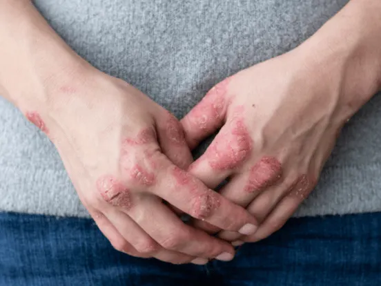 Hands clasped together with red, scaly patches on the knuckles and fingers.