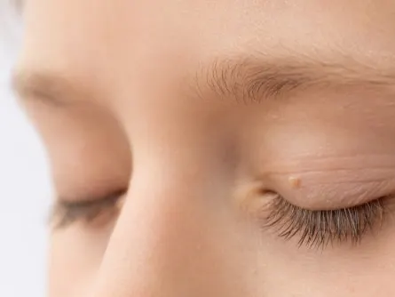 niña con papilomas en la piel alrededor del ojo