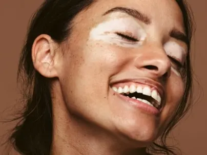 A smiling woman with eyes closed and light patches of skin around her eyes, against a brown background