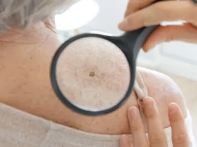 A clinician holding a magnifying glass over a mole on an older woman's shoulder