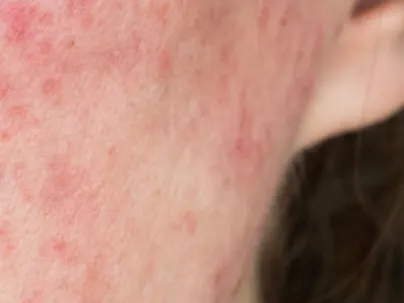 Close-up of red, blotchy patches of skin on a woman's cheek