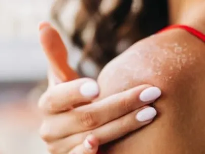 A woman touching her shoulder, which shows dry, flaking patches of skin