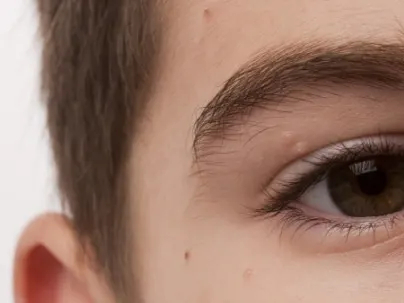 Close-up of a boy's eyes and forehead with several small, round, pearly bumps on the skin
