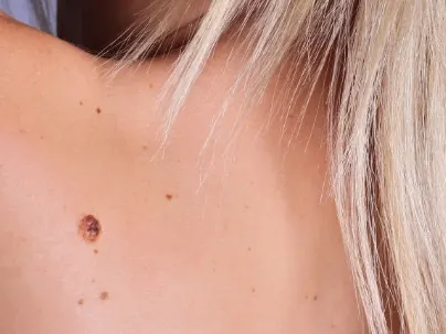 A woman's bare back and shoulder with several small moles and one larger brown mole