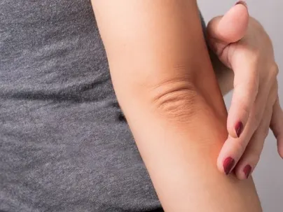 A woman holding her fingers to her elbow, which shows a patch of redness