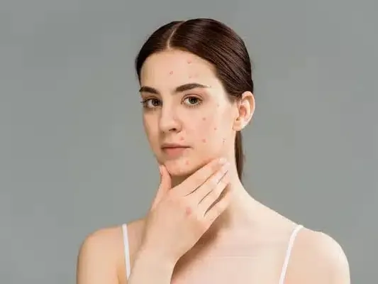 molusco contagioso