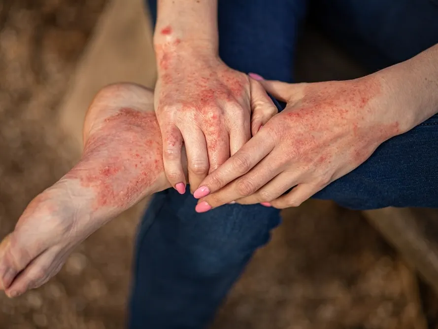 dermatitis por eczema en manos y pies