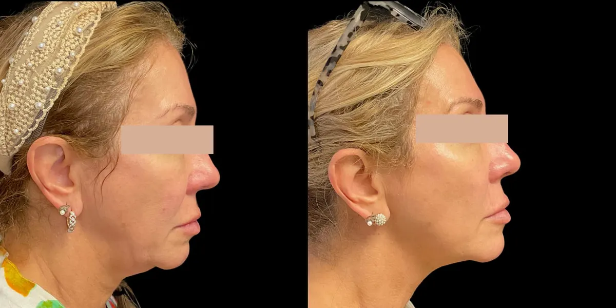Antes y después de la cirugía estética Morpheus en Hollywood, Florida