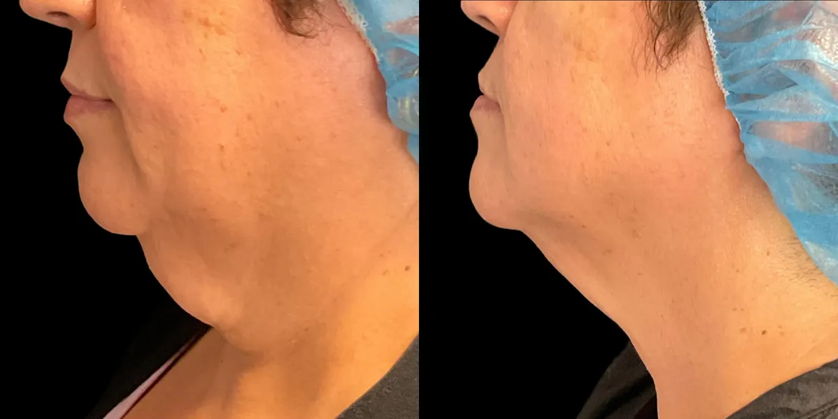 Antes y después de Morpheus Neck, condado de Broward, FL
