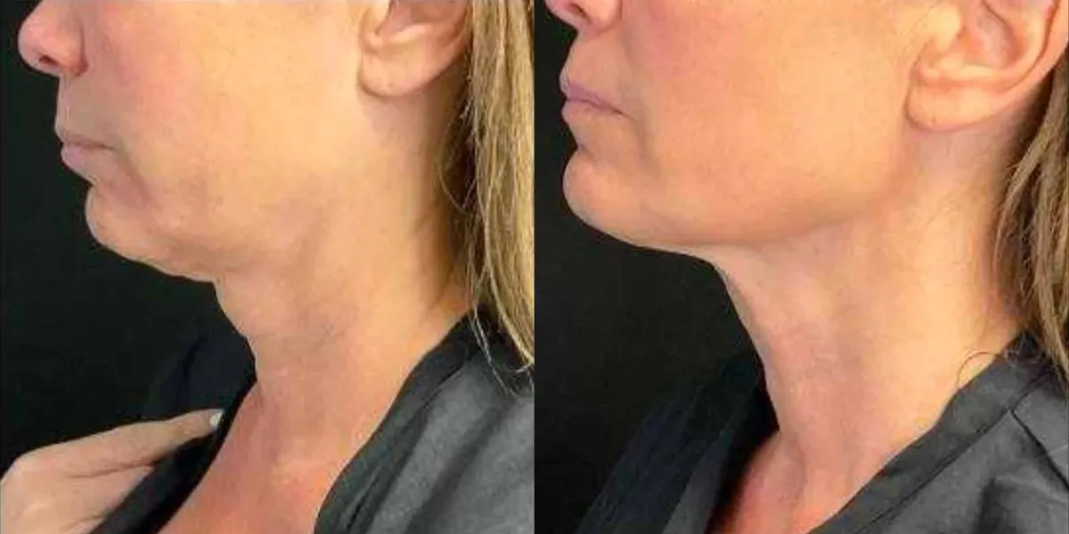Antes y después de Morpheus8 Neck Hollywood FL