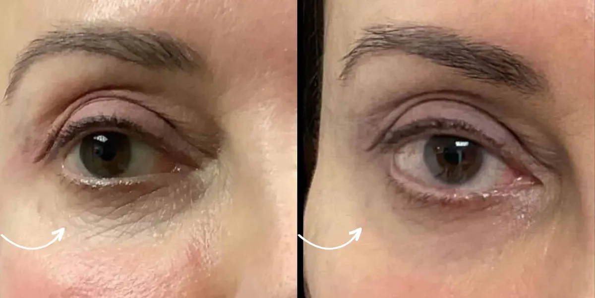 Antes y después de Morpheus8 Undereye Broward County FL